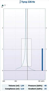 interpreting tympanogram|Understanding Tympanometry: A Comprehensive Guide.